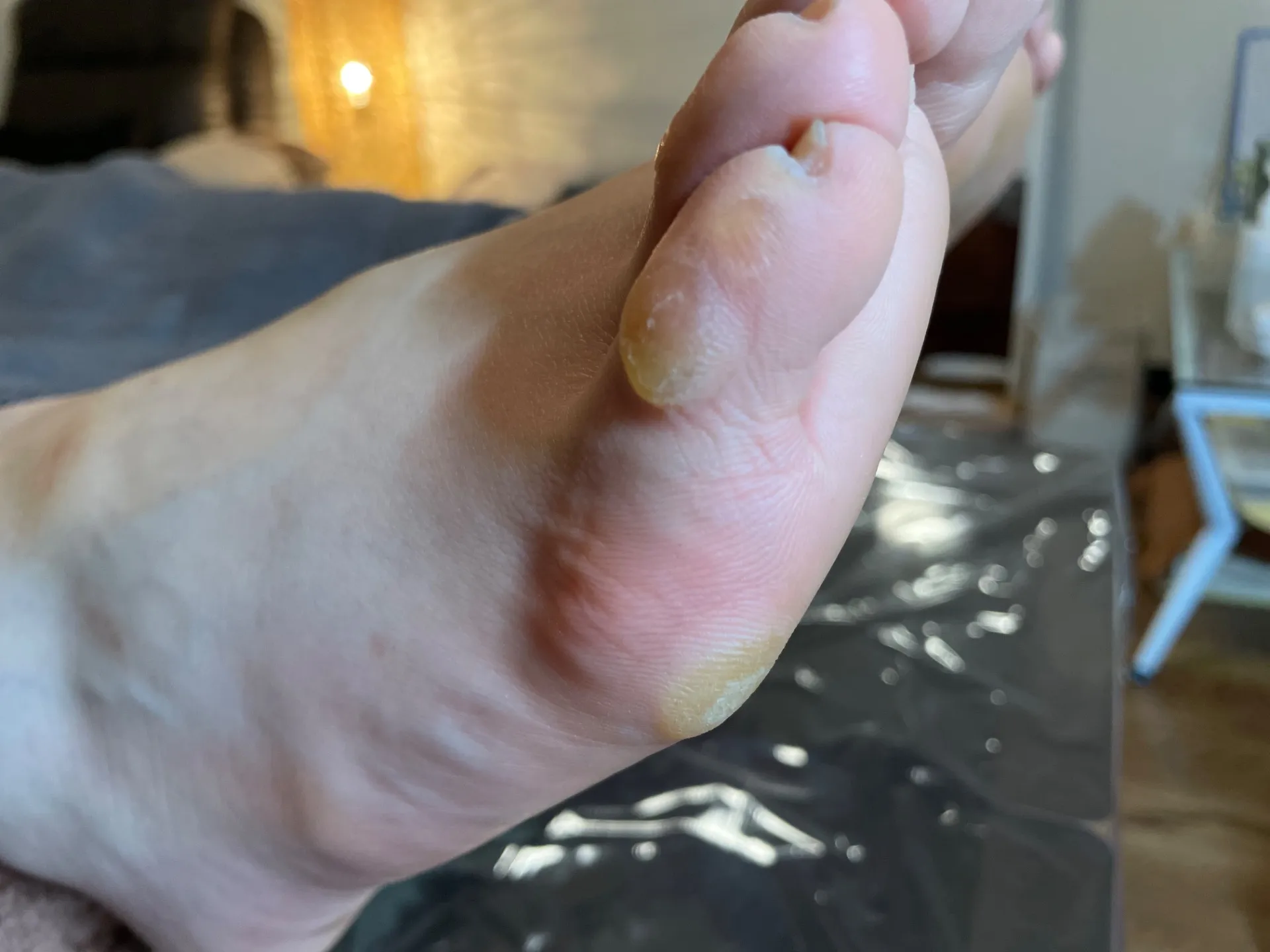 足指にタコはありませんか?